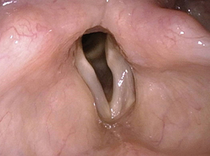 Recurrent_nerve_paresis